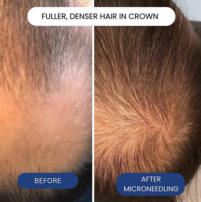 Peptonix Micro-Infusion System For Hair Regrowth