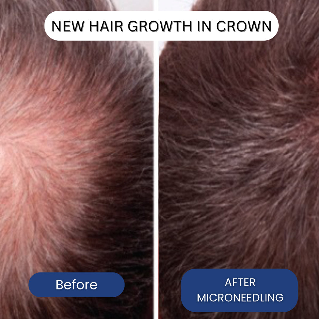 Micro-Infusion Peptide System For Hair Regrowth.